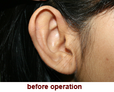 plastic-surgery-prominent-ear 